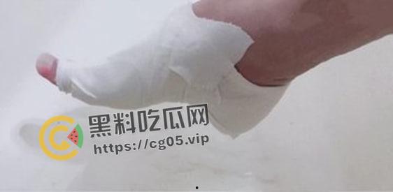 新时代裹脚女性！00后女生爱上裹脚 推特分享裹脚经历 把脚缠到骨折变形 吓人！-10