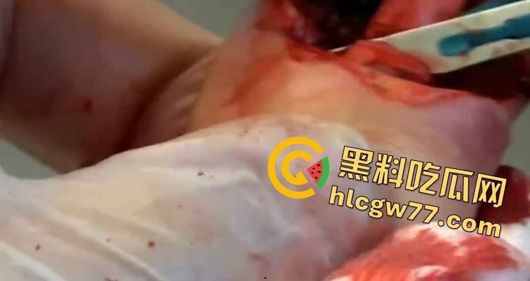 患者天天啃脚指甲狂得甲沟炎！帕尔米耶里手术刀下血肉狂飙，操刀医生差点呕吐！-1