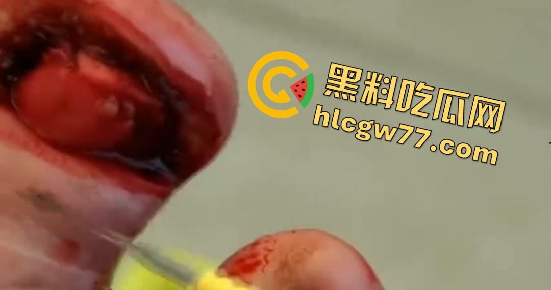 患者天天啃脚指甲狂得甲沟炎！帕尔米耶里手术刀下血肉狂飙，操刀医生差点呕吐！-8