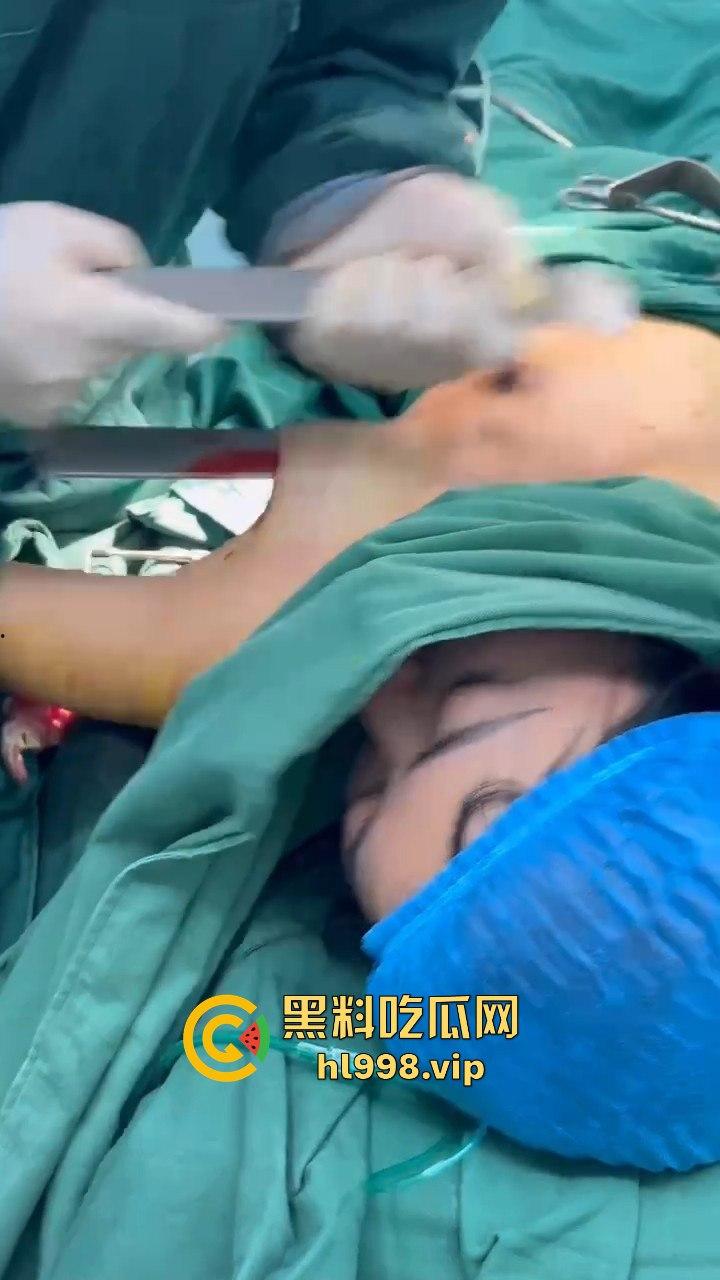 揭秘黄晓明女友『叶柯』同款隆胸术手术过程，看的让人心惊！胸被医生猛戳猛捣，视觉冲击强到不敢看！-6
