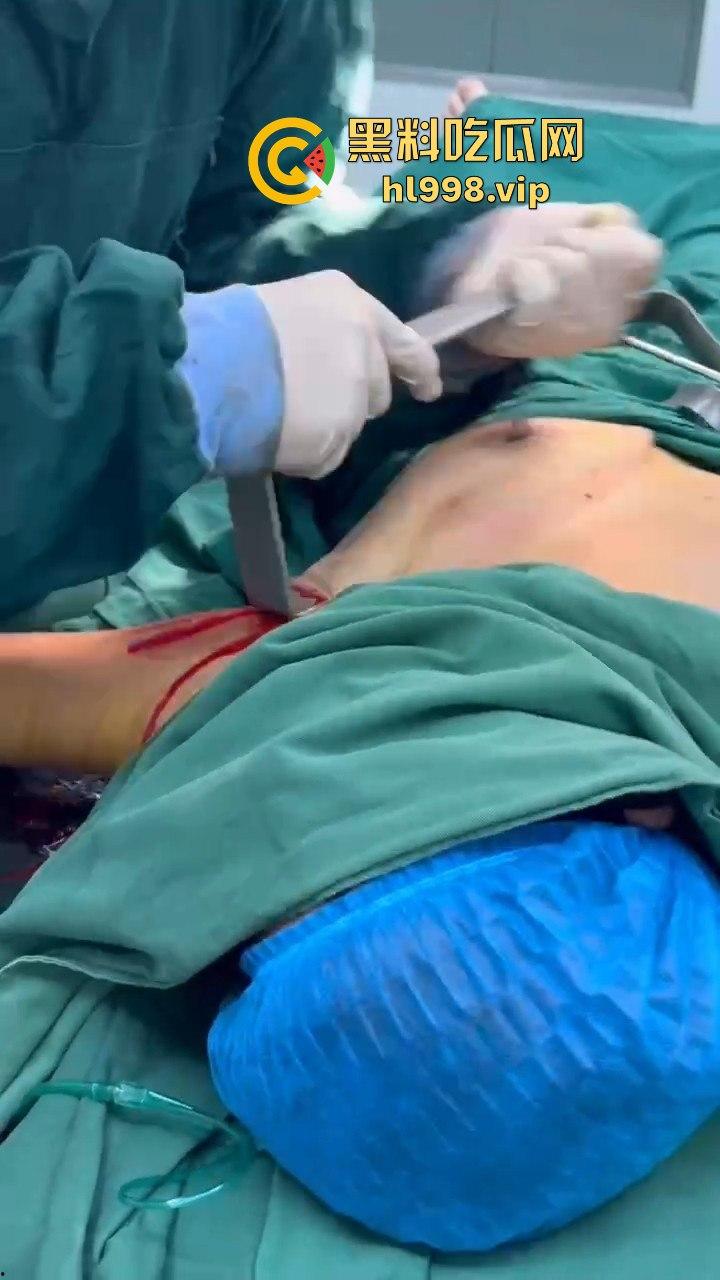 揭秘黄晓明女友『叶柯』同款隆胸术手术过程，看的让人心惊！胸被医生猛戳猛捣，视觉冲击强到不敢看！-13