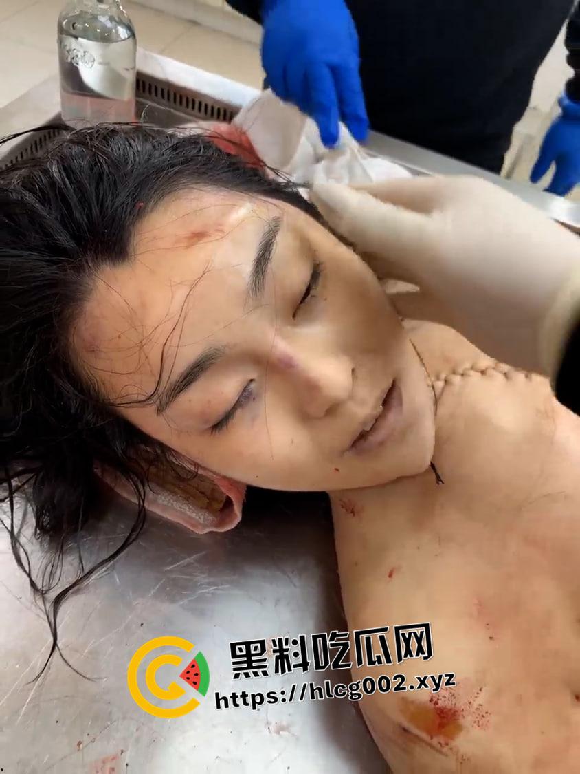 恐怖慎入!辽宁【徐园】案尸检现场视频流出 被前男友家暴致死打的面目全非-9