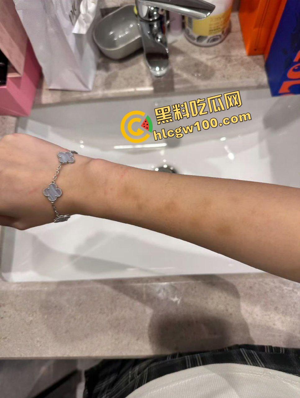 街球圈情侣大瓜!杭州街球手【程鑫凯】家暴女网红【鸡腿诺】多处打伤哭泣现场!独家开盒流出!-14