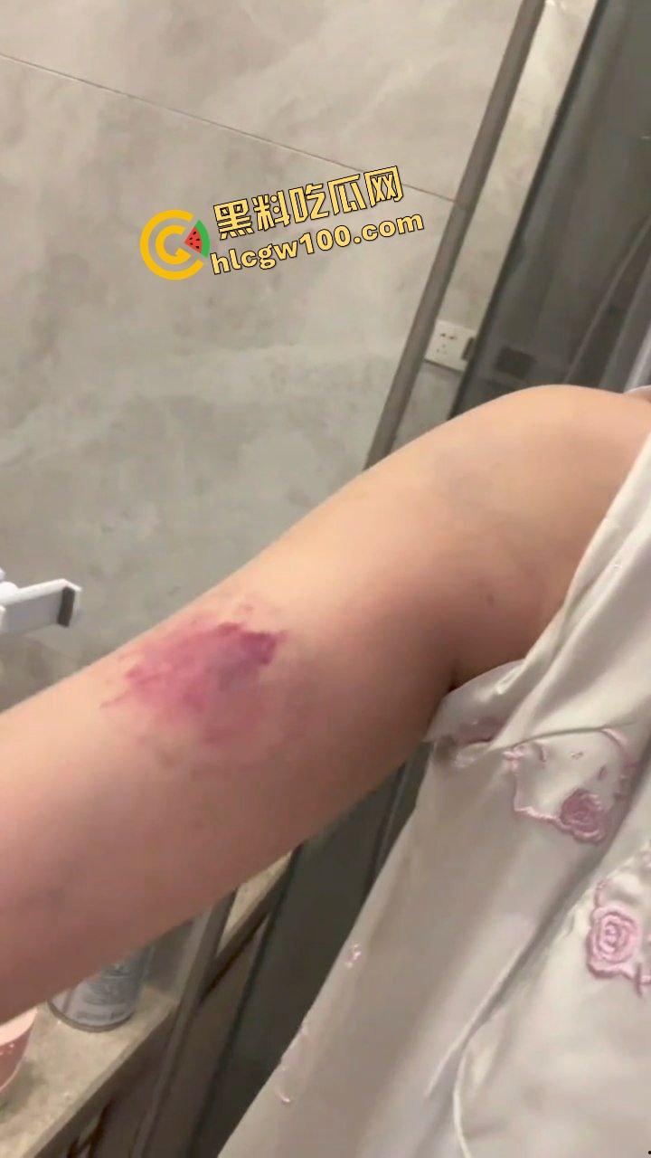 街球圈情侣大瓜!杭州街球手【程鑫凯】家暴女网红【鸡腿诺】多处打伤哭泣现场!独家开盒流出!-16