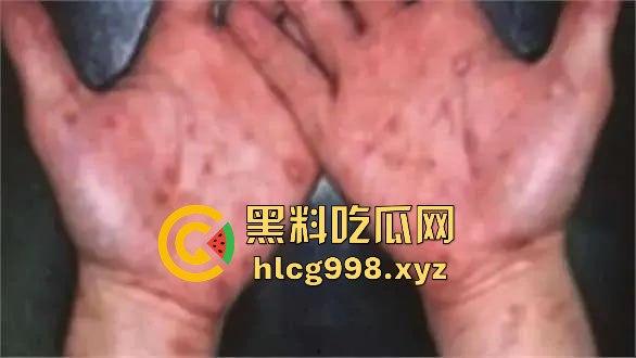 梅毒像疯狗一样乱咬！日本疫情横扫全球，日本卫生部出狠招断根大法安排上，管不住下半身只能禁爱？-12