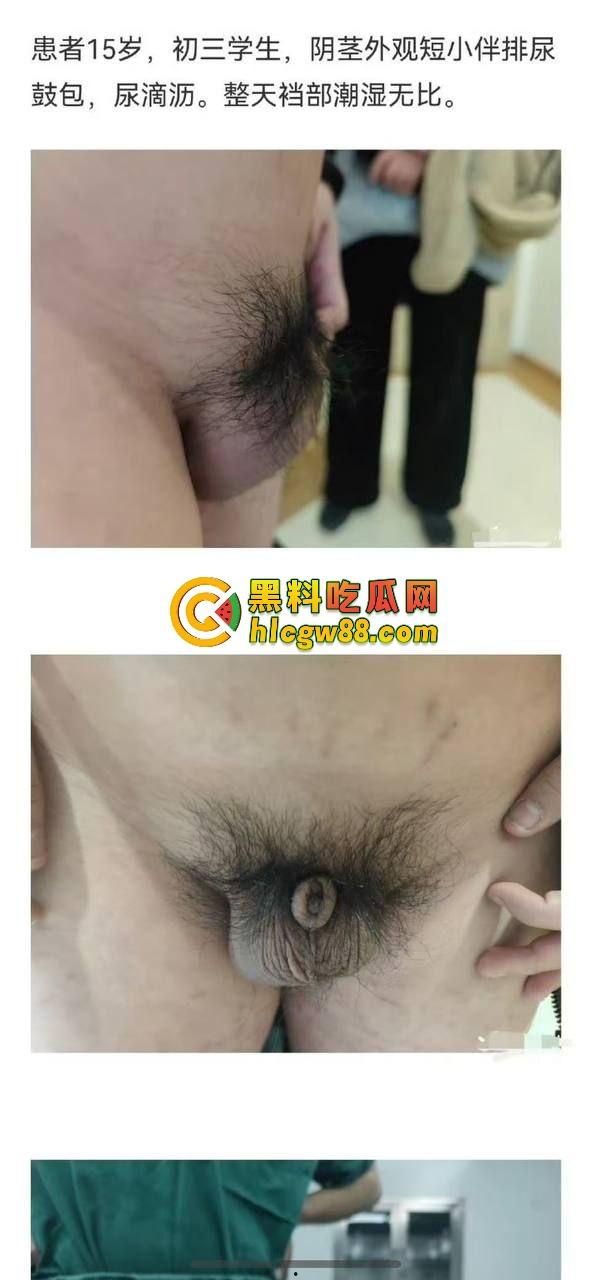 小鸟变大雕换炮计划！阴茎增大手术震撼实测 9CM秒变18CM战神之枪 ，这根真的压不住了！-4