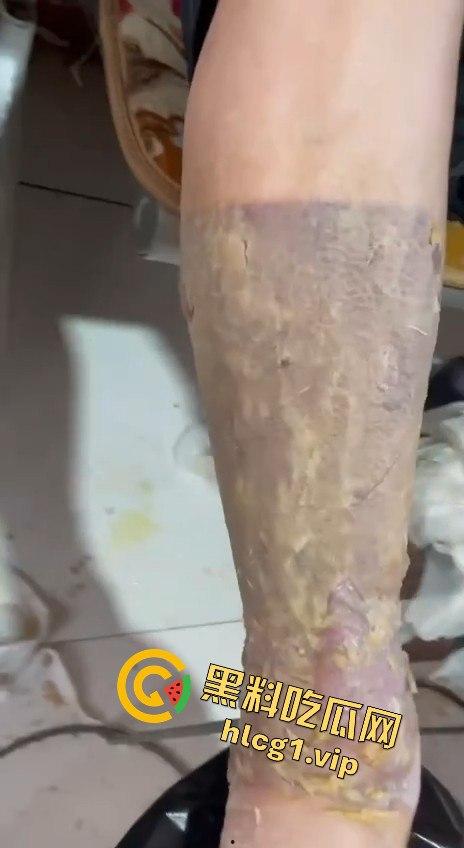 内蒙古呼和浩特惊魂一刻！02年精神小伙偷骑V4机车撞上右转SUV，摩托车当场燃烧！-11