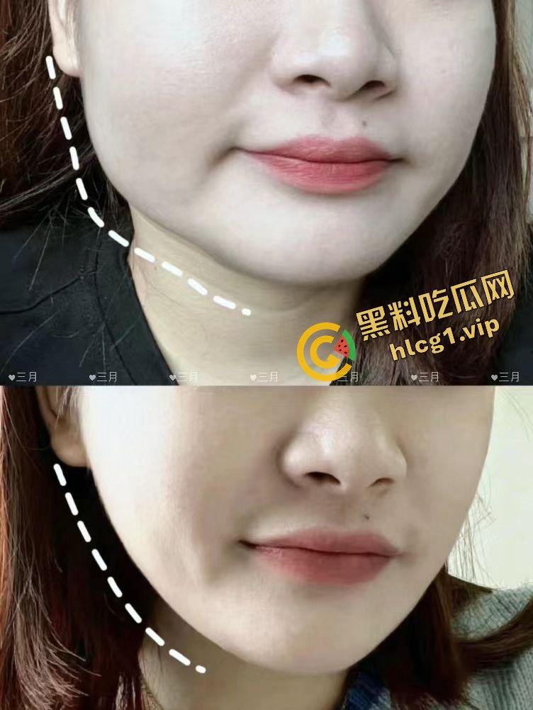 每个人体质不一样！瘦脸医美针害死人！肉毒整容 那女的 变 那女神！-12