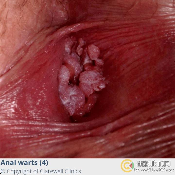 性病篇  谨慎观看！瓜友们出门在外 一定得洁身自爱 世界上没有后悔药  安全第一！！！ （二）-5