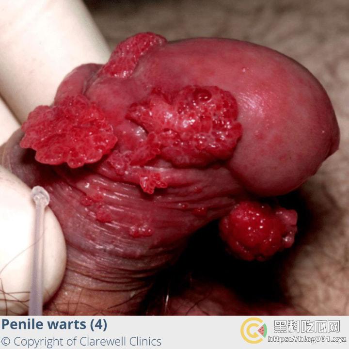 性病篇  谨慎观看！瓜友们出门在外 一定得洁身自爱 世界上没有后悔药  安全第一！！！ （二）-12